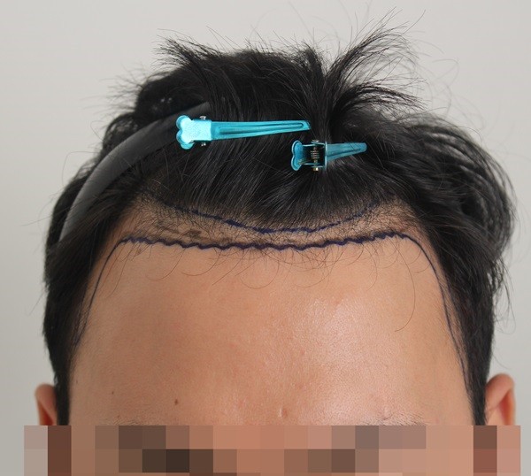안녕하세요 수술 6개월차 포토후기 가지고 왔습니다
