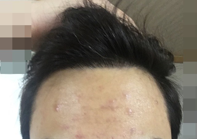 비절개수술 후 9개월째인데 흰머리도나와요