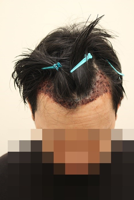I had a 3,620-mo incision last week.