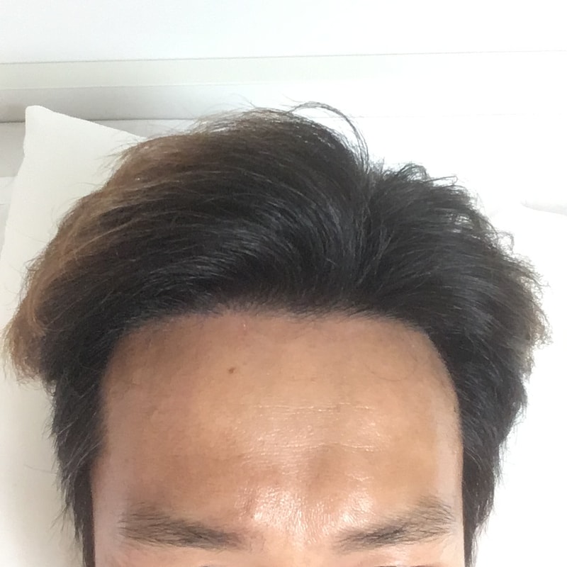 뒤늦은 12개월 후기 및 20개월 상태