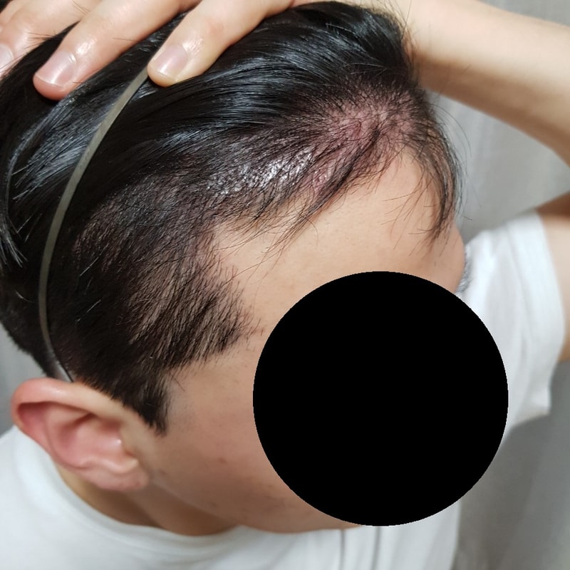 모발이식 수술 후기 3개월 경과 남겨보겠습니다