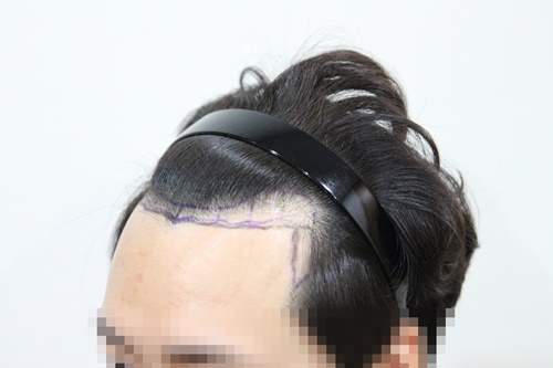 수술 전 모자이크 2.JPG