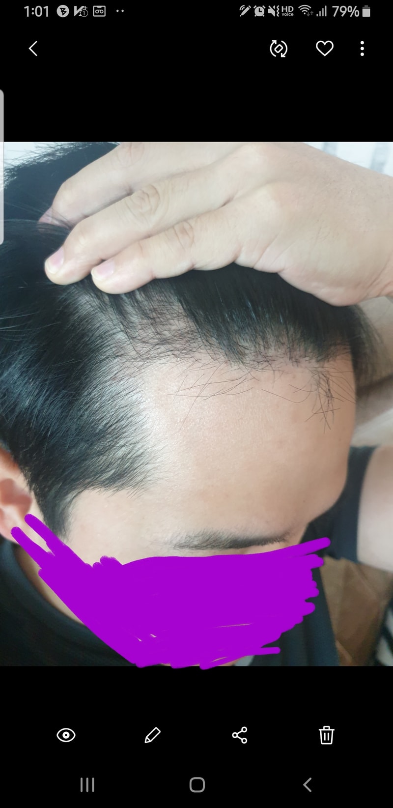 수술후 4개월차 입니다.