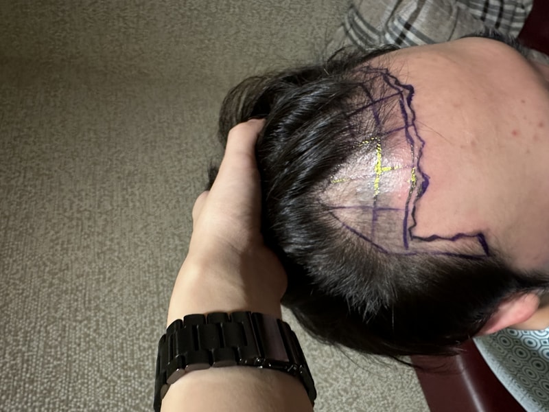 It's a review of non-cut hair transplantation on the 7th day of New Hair 2000 hair follicles
