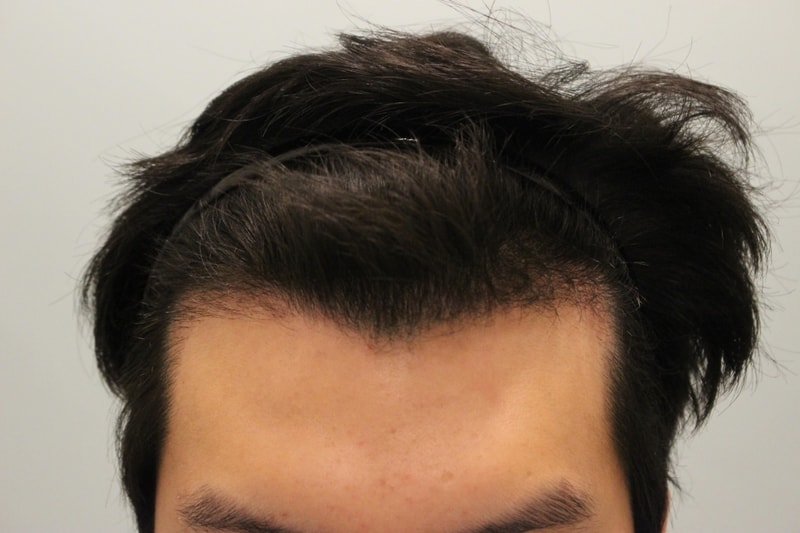 수술후 2개월.jpg
