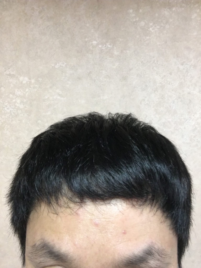 모재성 비절개 1700모낭 이식 8개월 경과 평가 부탁드립니다.