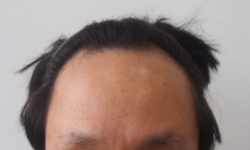 비절개 부분삭발 1700모낭 정도 모발이식 평가 부탁드려요.