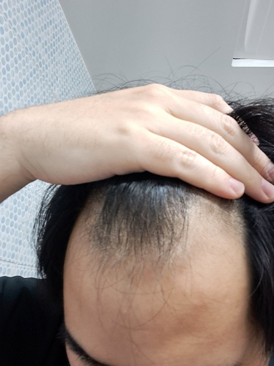 모원성형외과 부분삭발비절개 모발이식 5일차 어떤가요? (정재홍원장님)