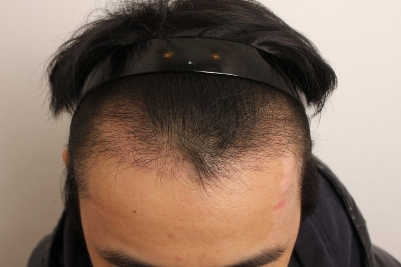 크기변환_3개월경과 (7).JPG