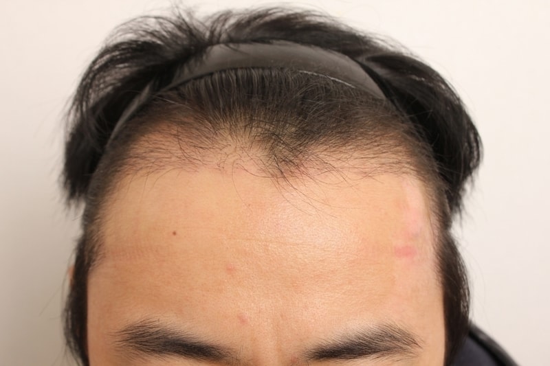 크기변환_3개월경과 (4).JPG