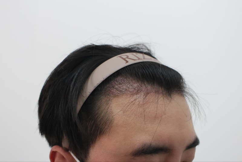 수술 120일차 좌.jpg