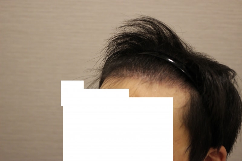 수술후 3개월 (12).JPG