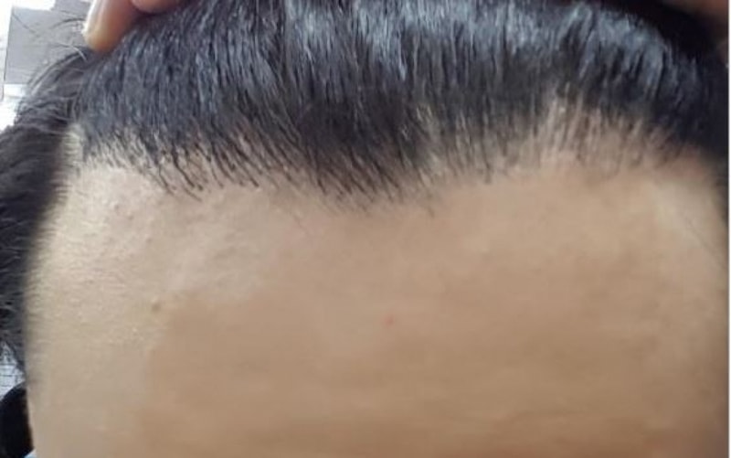 1차수술 후.JPG