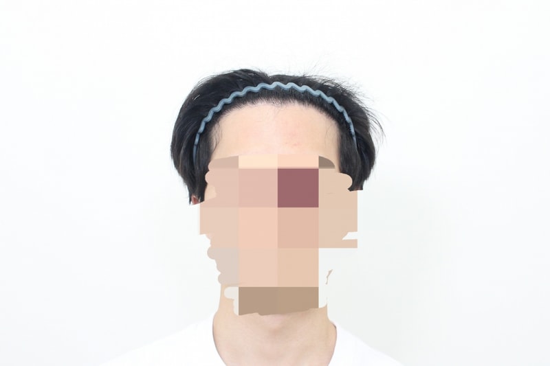 수술 후 정면.jpg