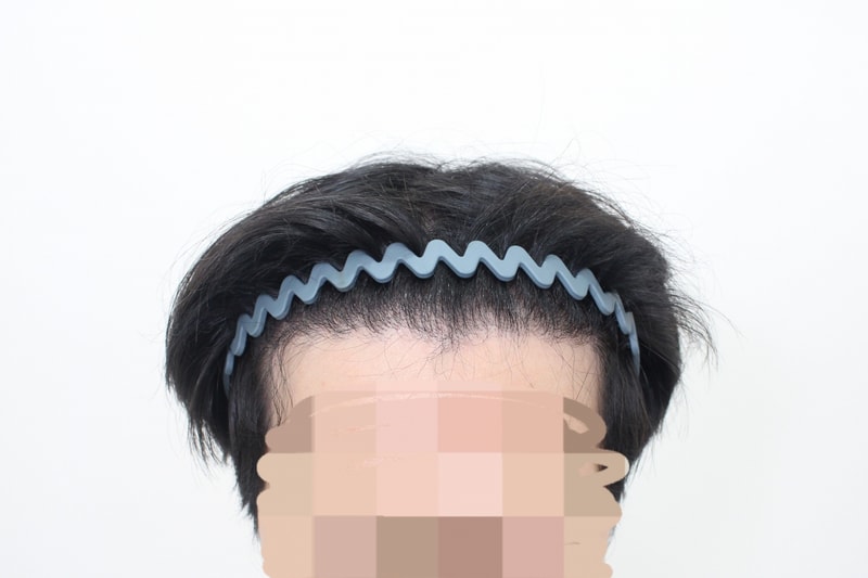 수술 후 위.jpg