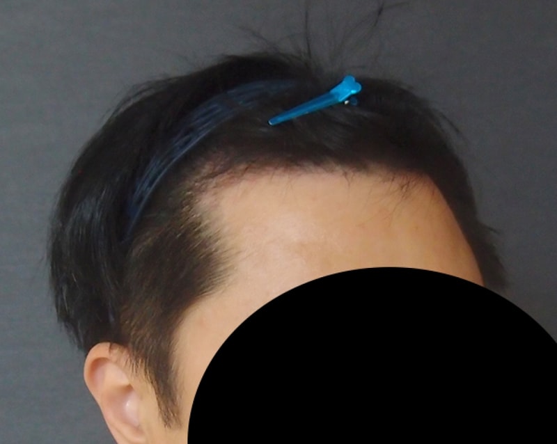 수술후3개월(3).jpg