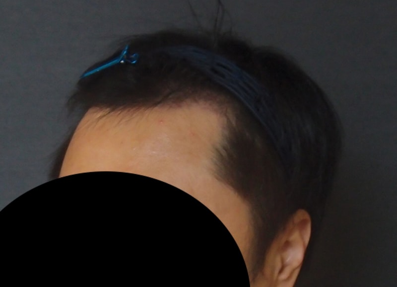 수술후3개월(4).jpg