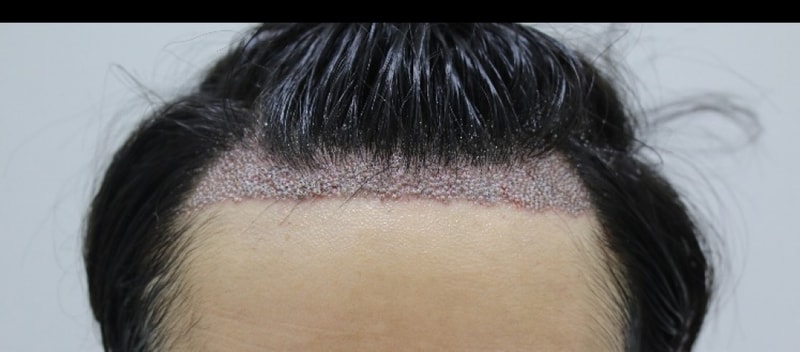 강남포헤어 이식후 굉장히 불만족 이후 A/S