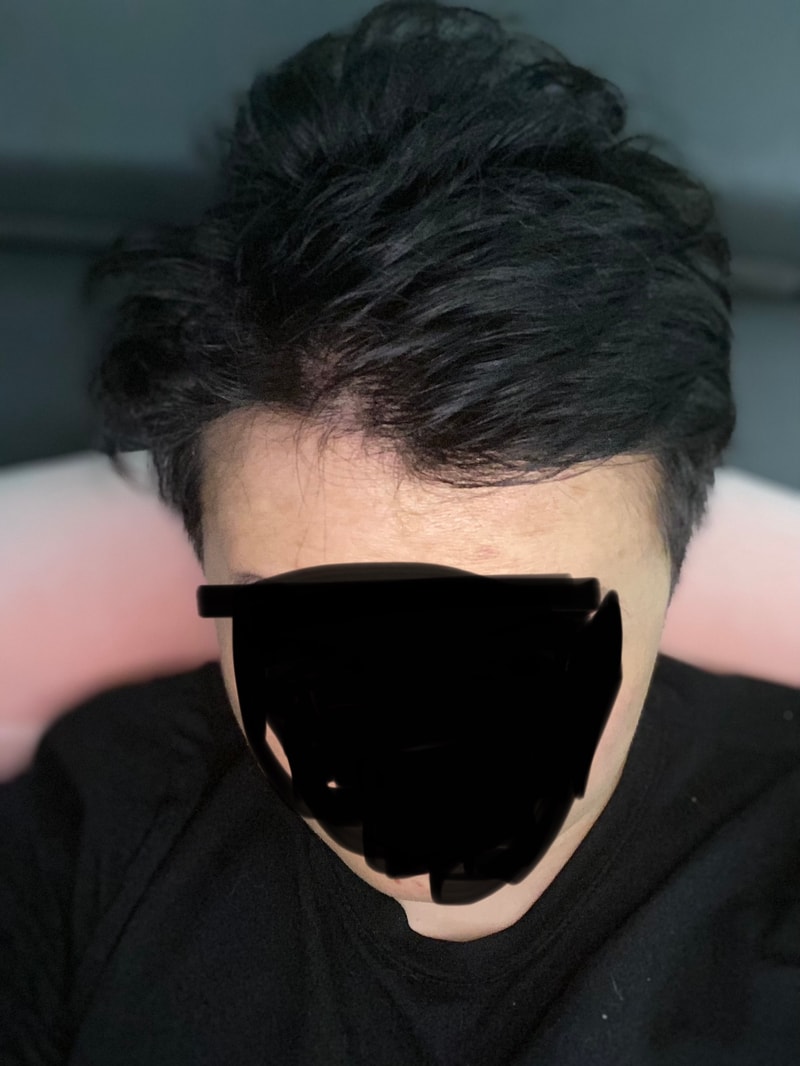 모발이식후4.jpg