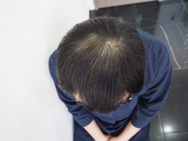 수술전 정수리.JPG