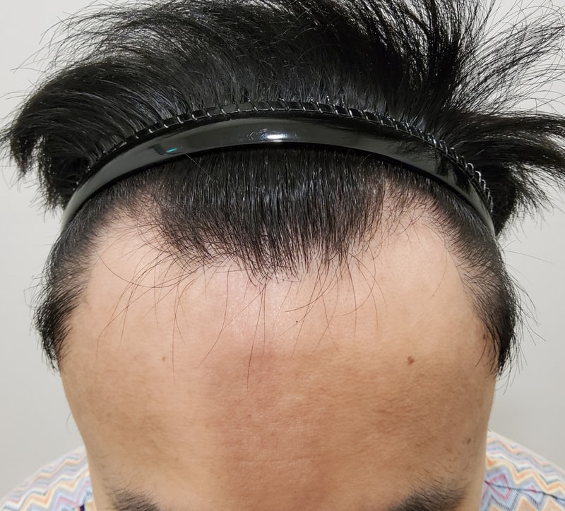 비절개모발이식 6개월 후기입니다.