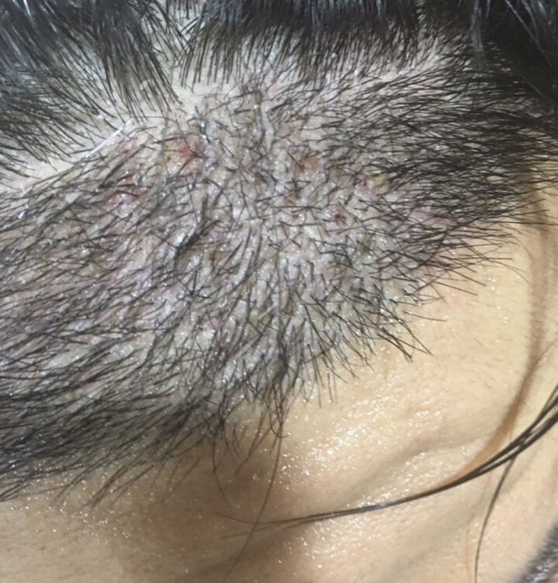 Mo Jae-sung's second surgery on May 25th. More than 4 months of review!