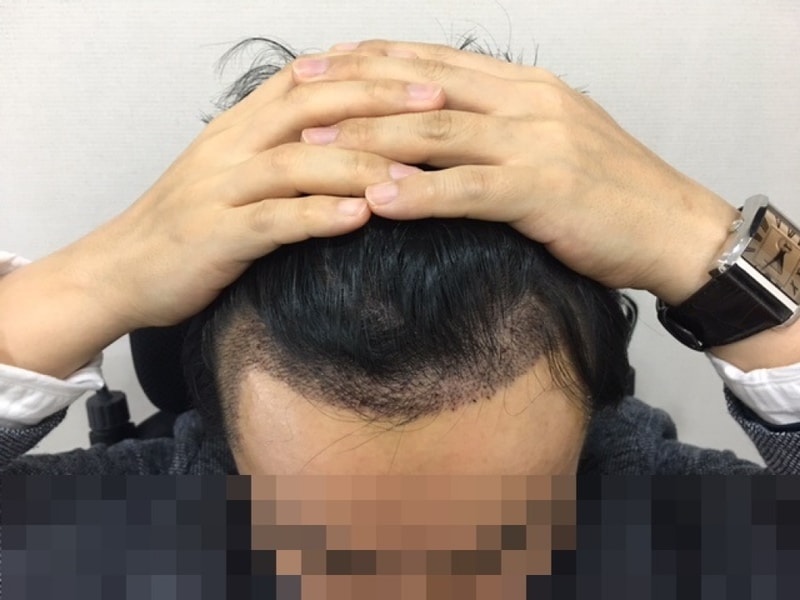 수술받은지 20일째입니다