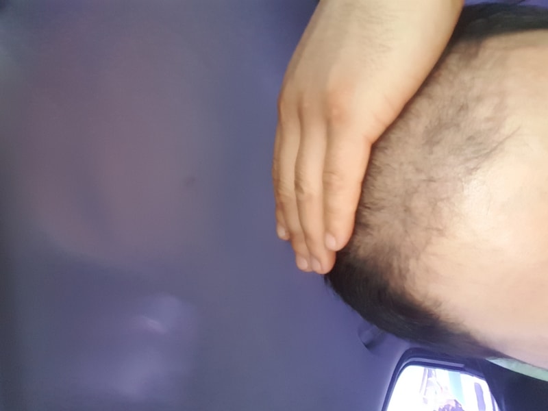 이식두달차입니다