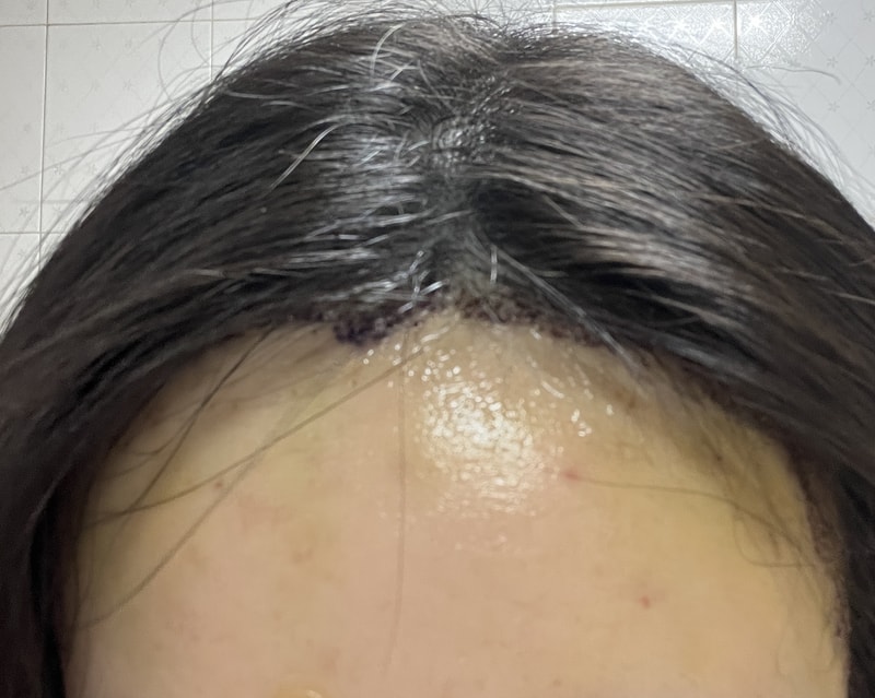 노블라인에서 여성 헤어라인 수술한지 일주일 됬어요!