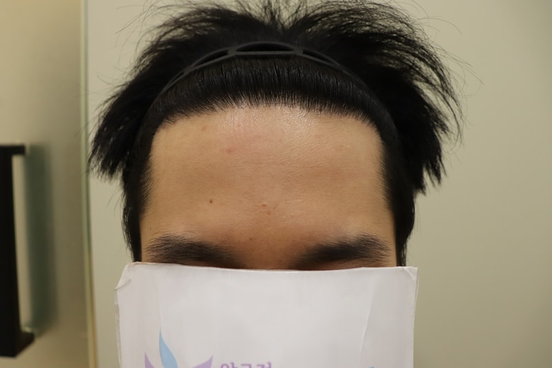 광주 압구정모비앙 모발이식 1년차 후기