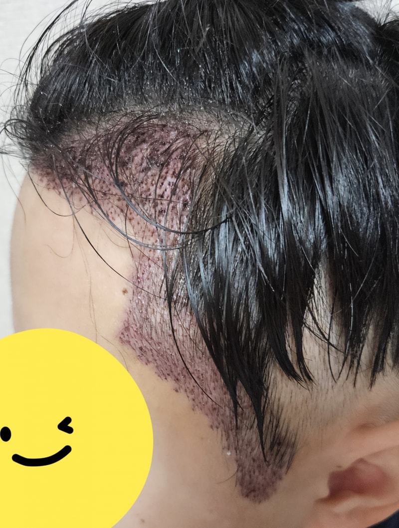 수술당일~한달경과