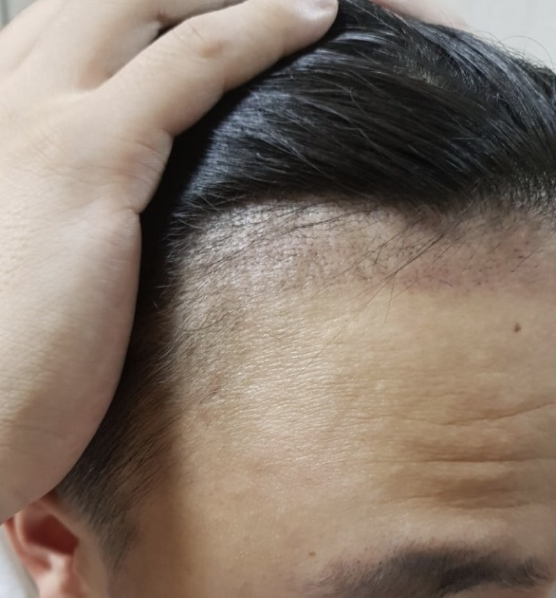 비절개 이식한지 71일 됬습니다