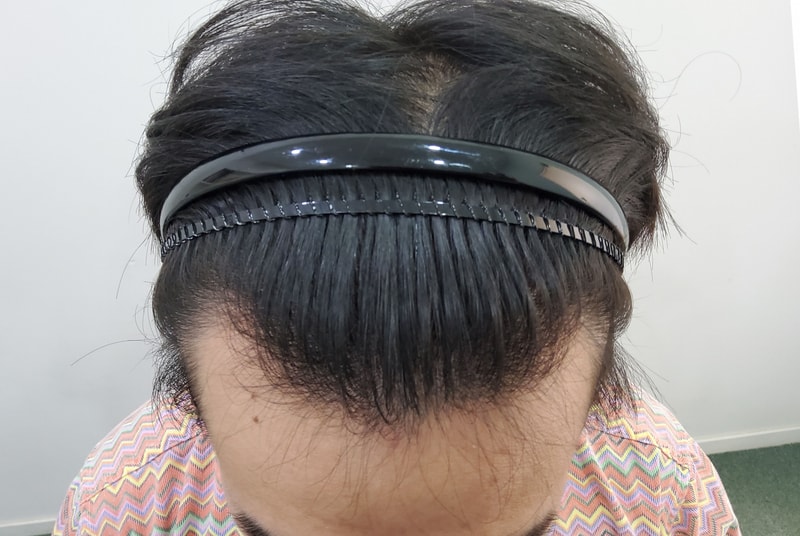 그저께 이식받았습니다