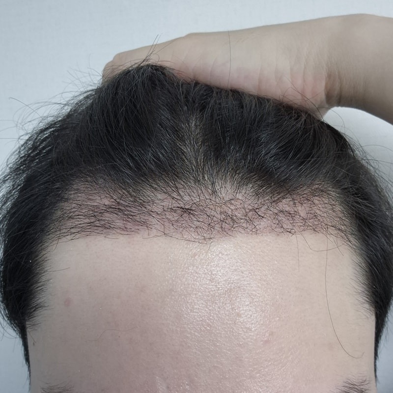 모제림 박세호원장님 한달후기!