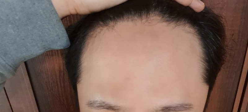 모바른에서 오늘 수술받고 집왔어요 절개 2914모