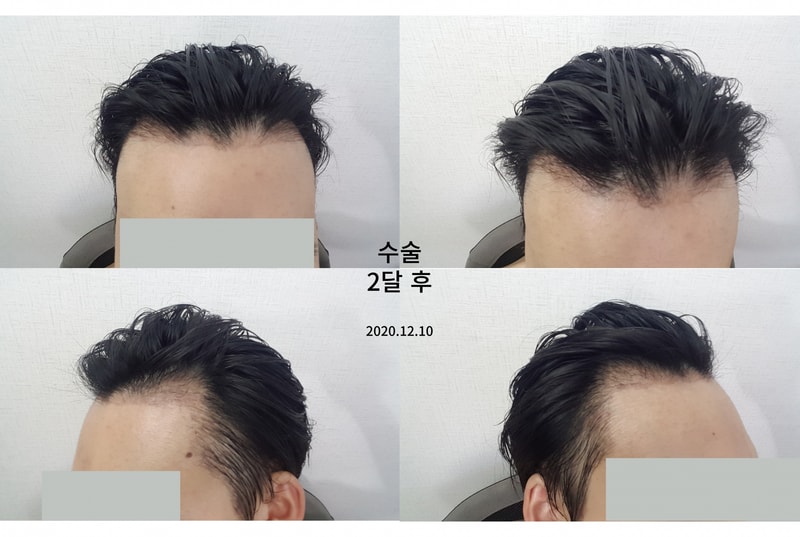 2달-후.jpg