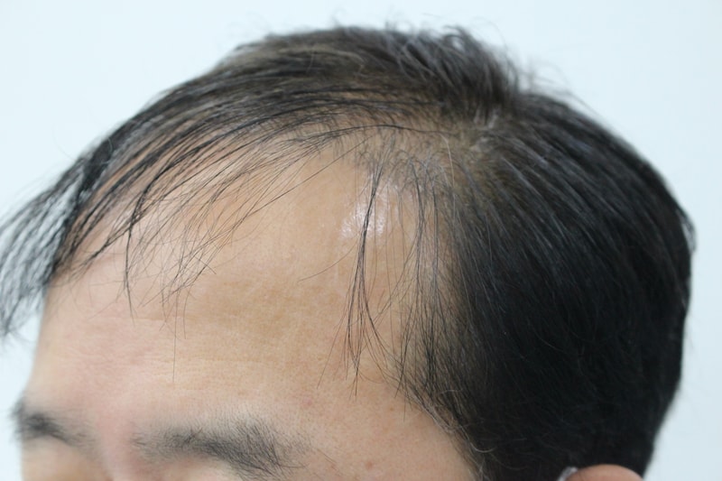 비절개 모발이식 후기에요