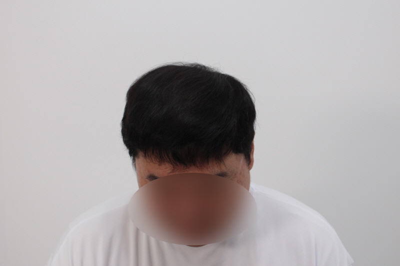 [크기변환]4. 수술후 12개월차.jpg