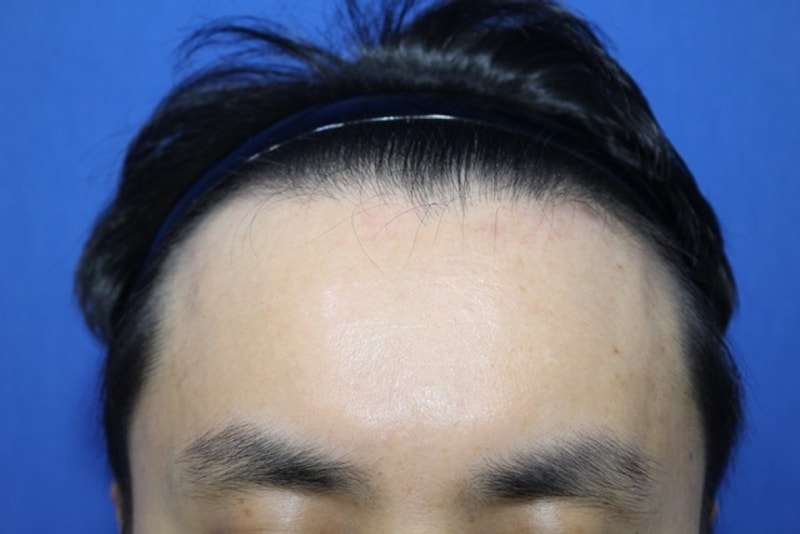 수술하고 이제 45일 됏어요