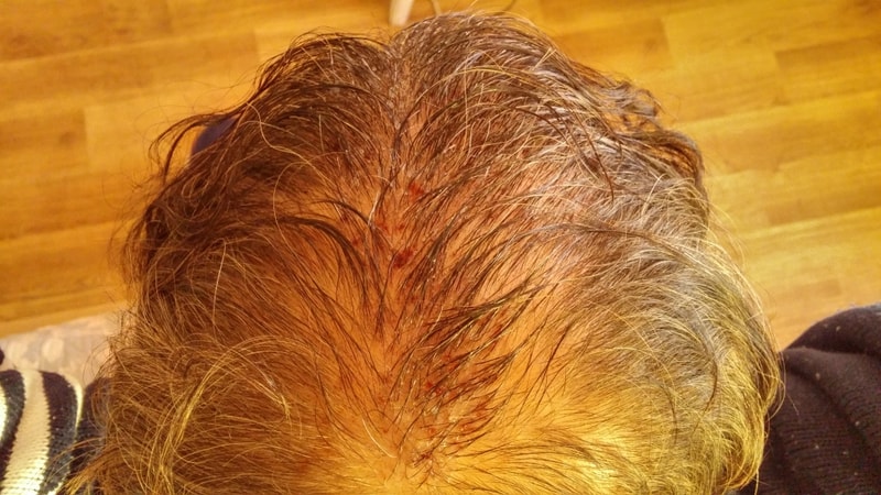 ニューヘアー切開法 手術後記