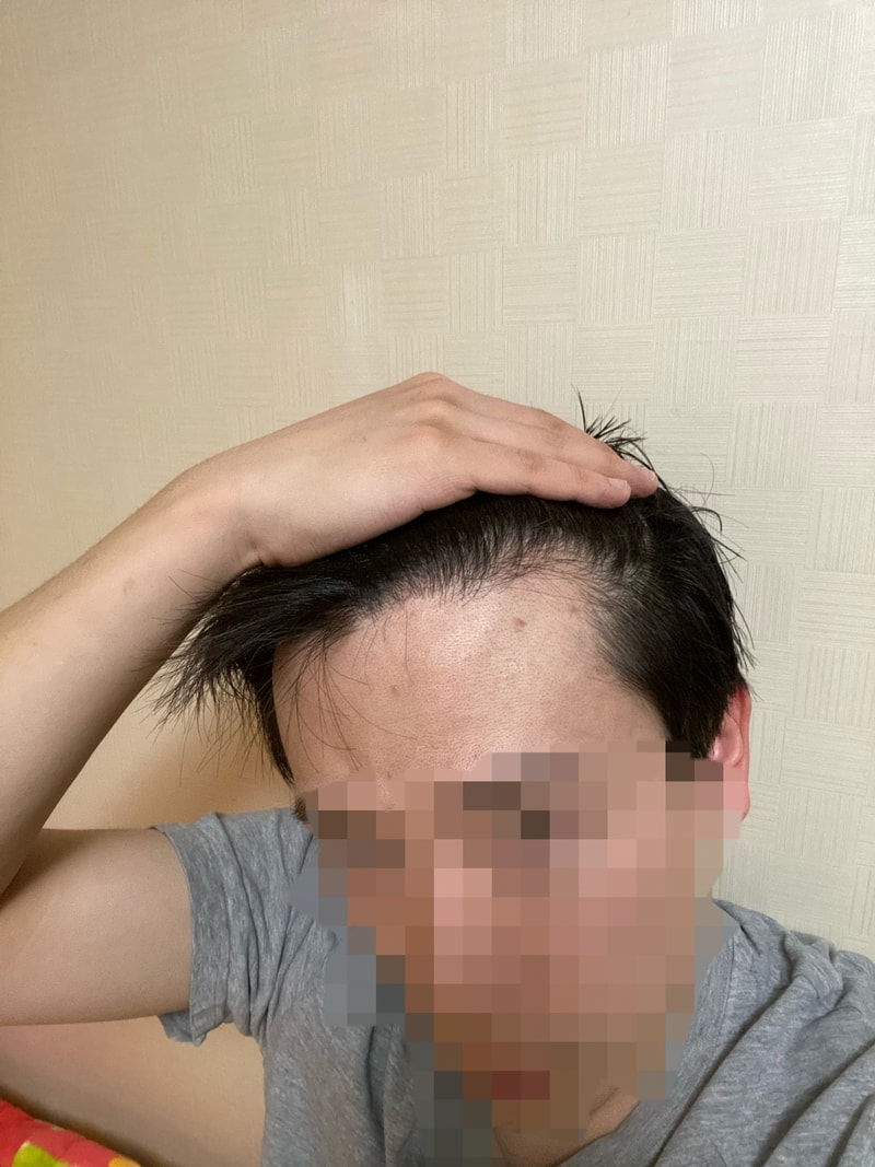 다나 4천모 두달경과 후기입니다