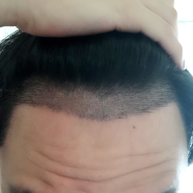 비절개 11일차 입니다.