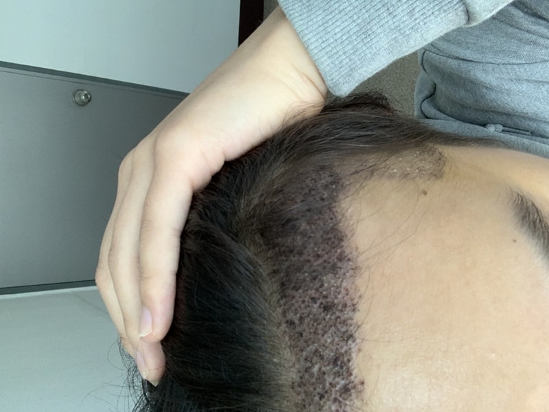 2000모낭 비절개 무삭발 7일차