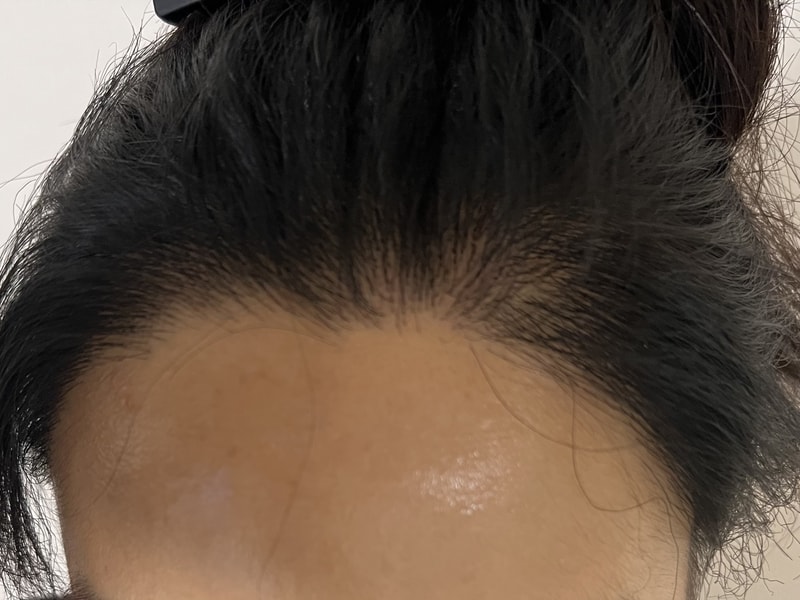 뉴헤어모발성형외과 모발이식 1600모낭 10개월 후기