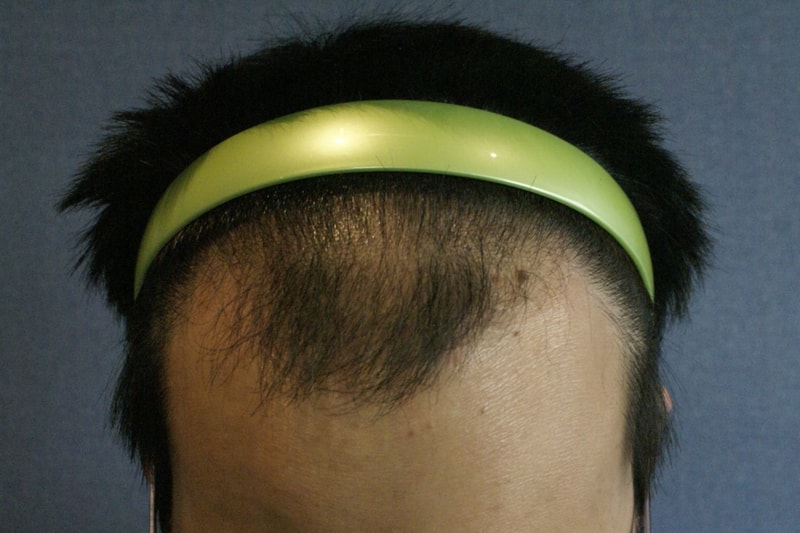 모션 1500모낭 이식