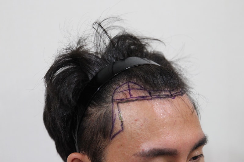 뉴헤어 일년 경과 입니다 !!