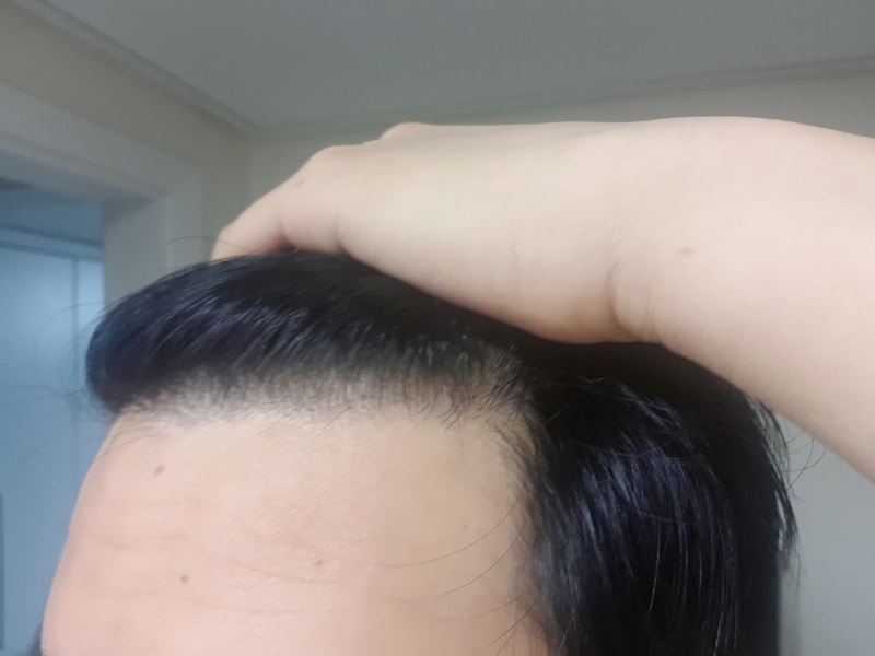 모재성 1550모냥 비절개 1년차입니다!