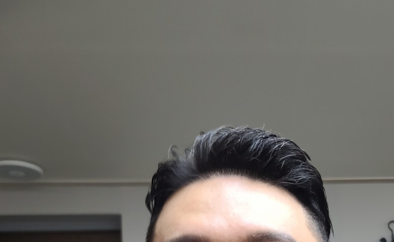 다나 무삭발 모발이식 15개월 현 스타일