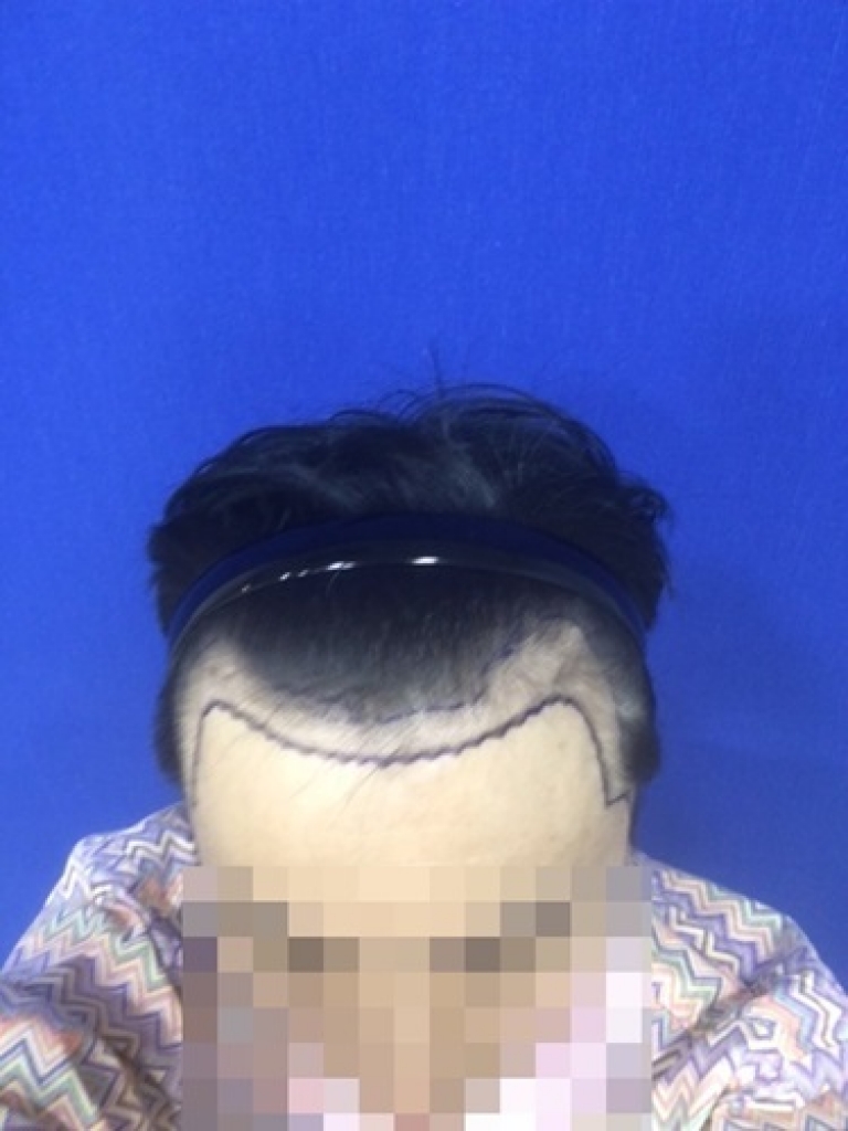 수술한지 3개월 약간 지낫어요