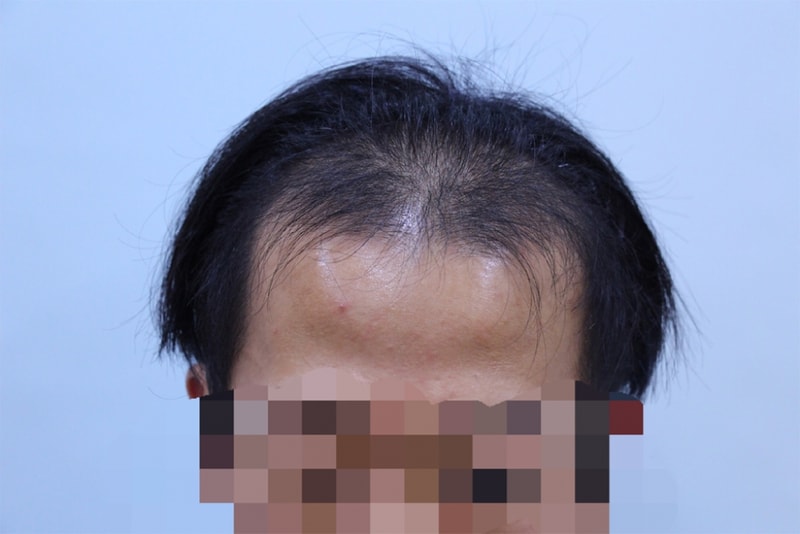 참닥터 비절개 후기 (1).png